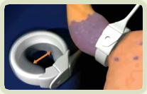 ρύθμιση δακτυλίου