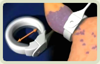 ρύθμιση δακτυλίου